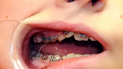 Load image into Gallery viewer, Tungsten Carbide Orthodontic Bracket Removing Pliers &amp; Wire Cuter Set
